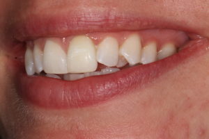 internal tooth whitening